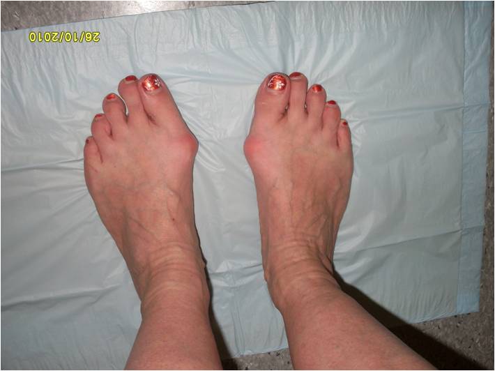 Hallux Valgus