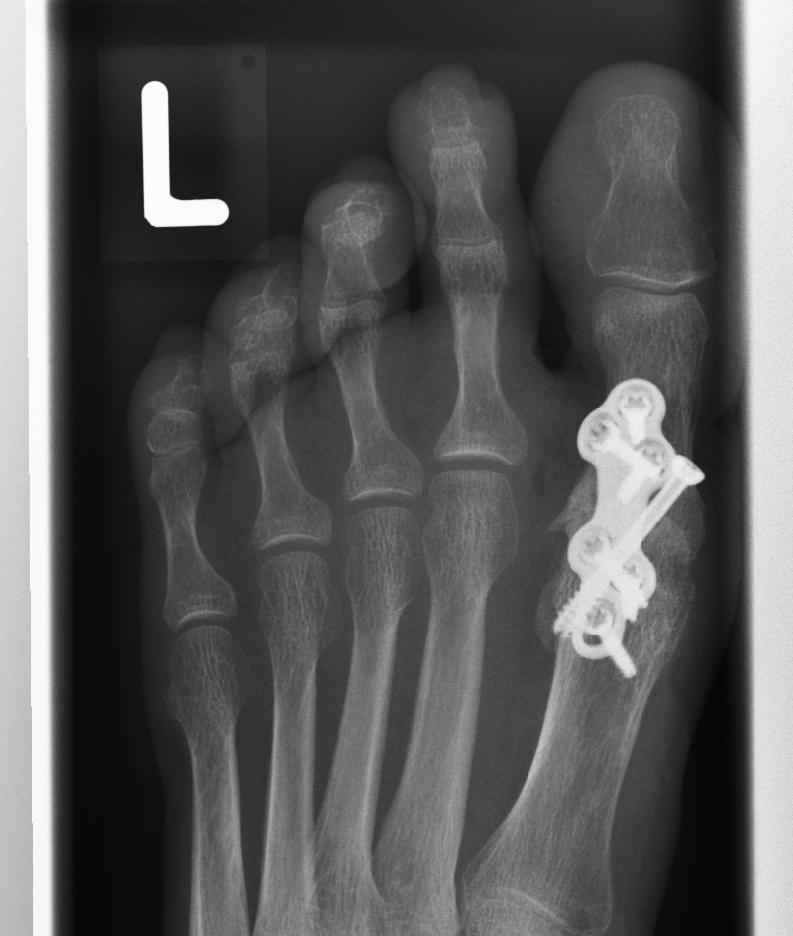 Hallux rigidus