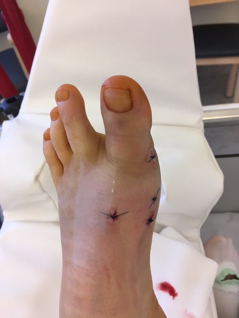 Minimalinvasive Fusschirurgie